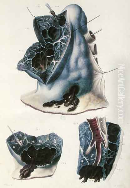 Diseases of the lungs, from 'Anatomie Pathologique du Corps Humain' Oil Painting by Antoine Chazal